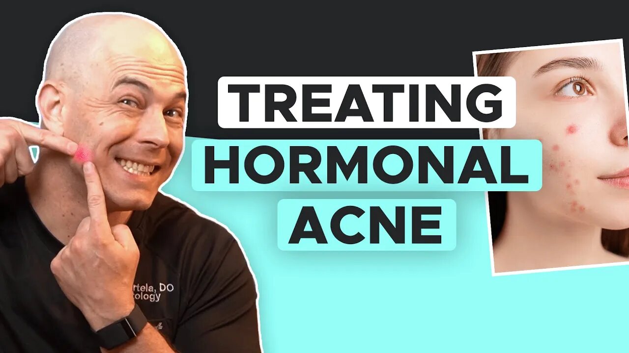 How To Overcome Hormonal Acne | Skin Care Tips