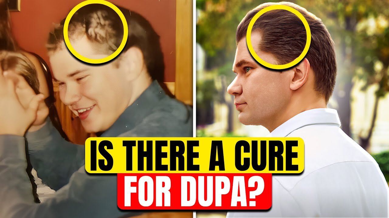 Diffuse Unpatterned Alopecia (Dupa)