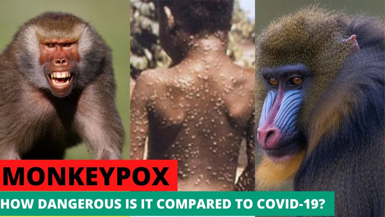 Monkey Pox vs COVID 19 Which is deadliest? Another Pandemic Ahead?