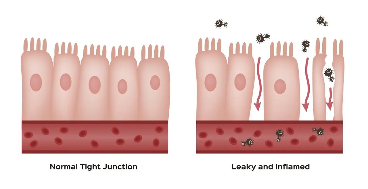 What creates leaky gut?