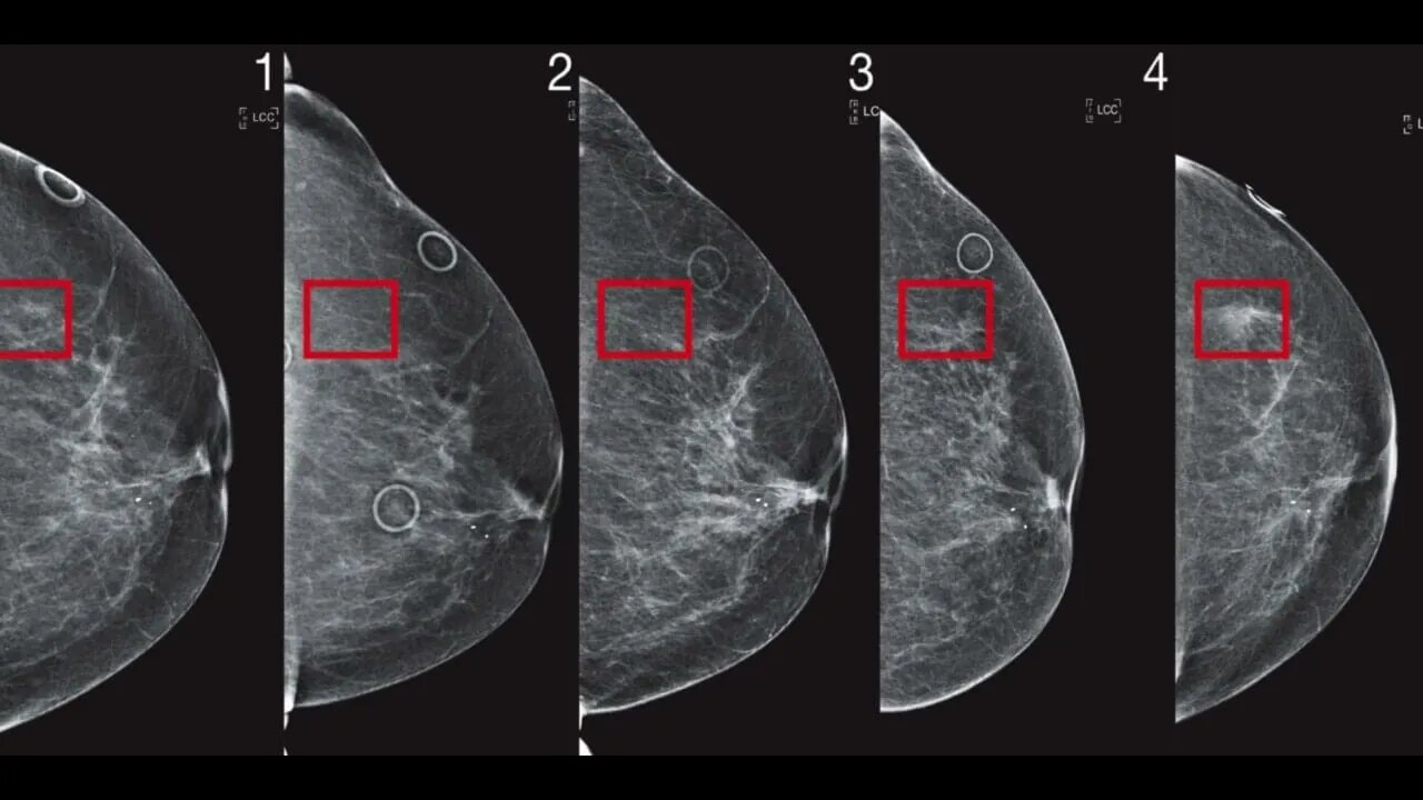 Not just a lump, 5 breast cancer signs many people don’t know about but should