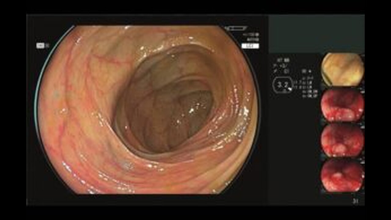 AI Revolution in Healthcare: Fujifilm's CAD EYE