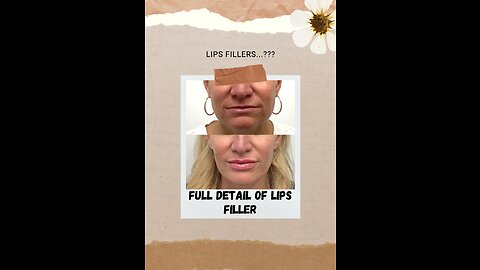 LIPS FILLER PROCEDURE | BENEFITS OF LIPS FILLER 💯🍒