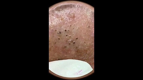 Blackheads episode 2