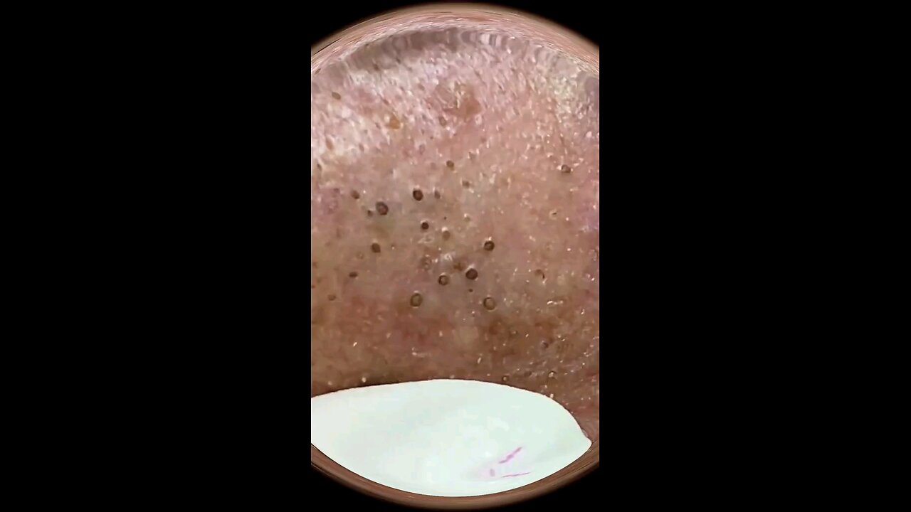 Blackheads episode 2
