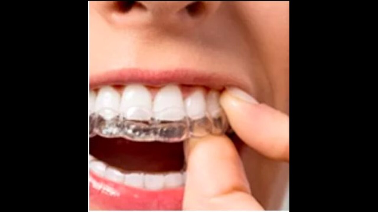 Clear orthodontics