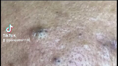 Stubborn Blackheads Popping!