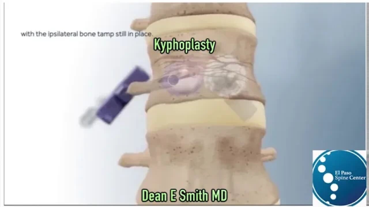 Should I have Surgery On My Lumbar Compression Fracture?