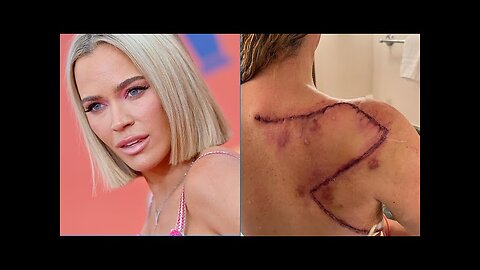 Teddi Mellencamp Reveals Large Scar Following Surgery