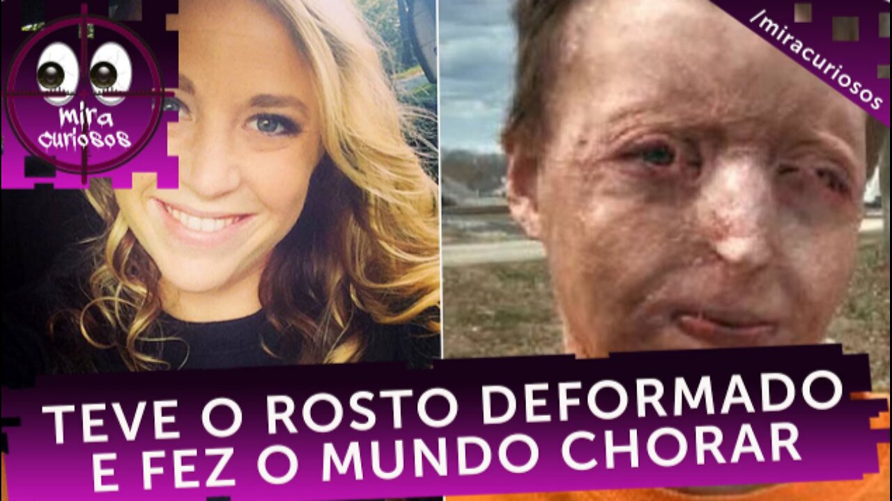 Husband accidentally throws gasoline on his wife's face and leaves her deformed. Her story...