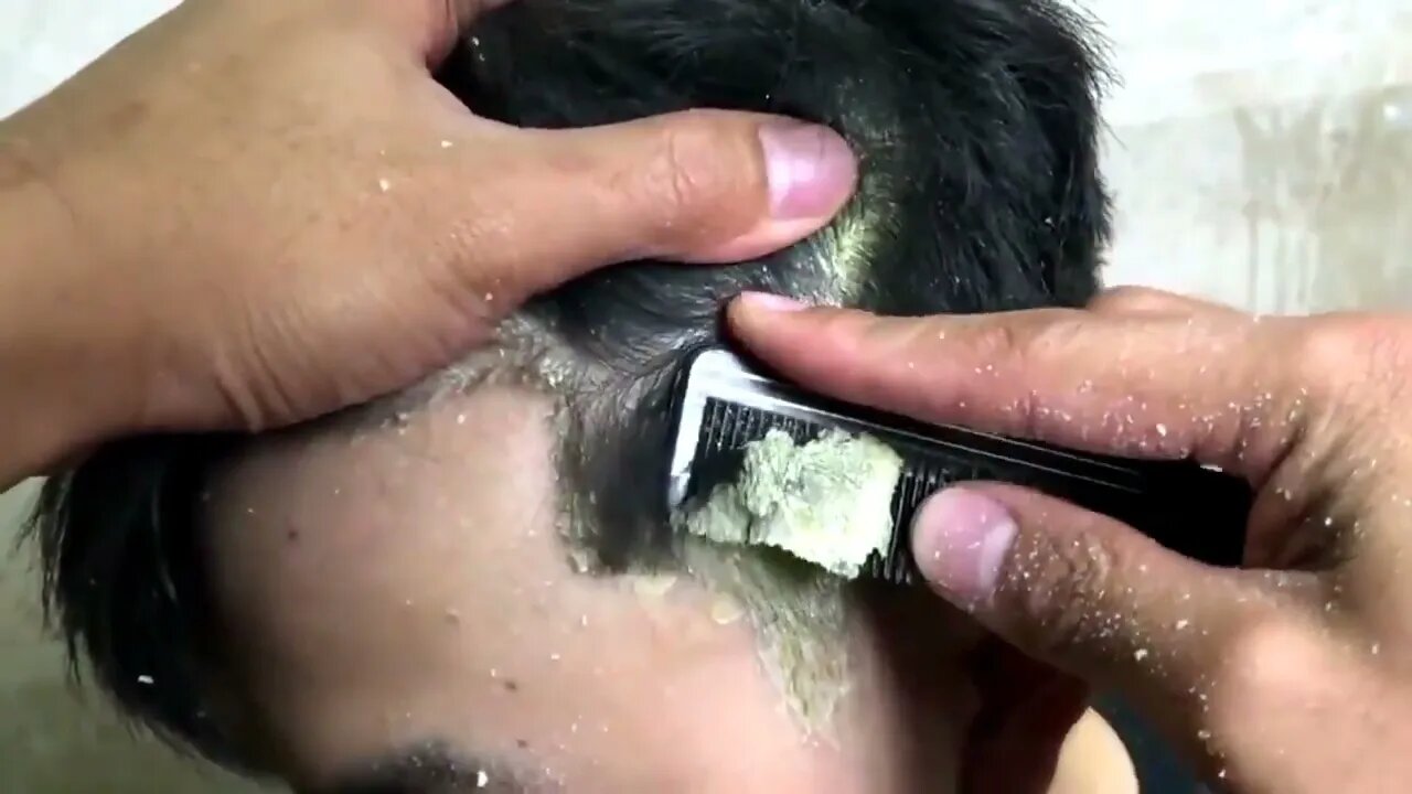 Whiteheads, Blackheads, Acne, and Cyst Removal, Hair and ingrown removal. | Oddly Satisfying Videos