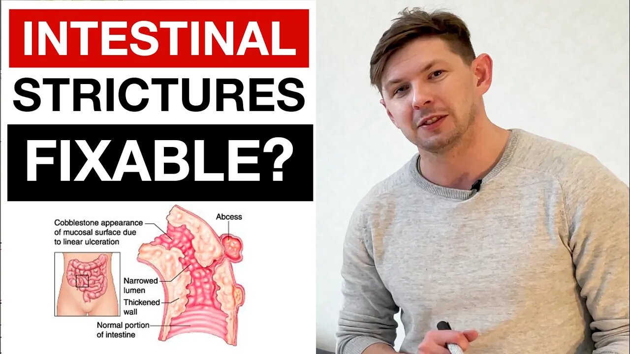 Options For Intestinal Strictures & Bowel Obstructions