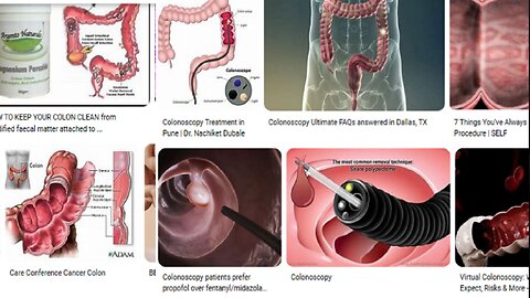 Slovenian police and hospital workers WILL CONFESS ABOUT COLON CANCER PRACTICE