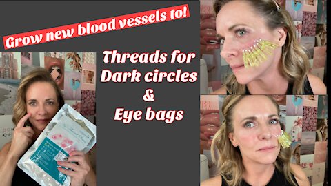 PDO Threads Under Eyes for Dark Circles | Also Grows New Blood Vessels