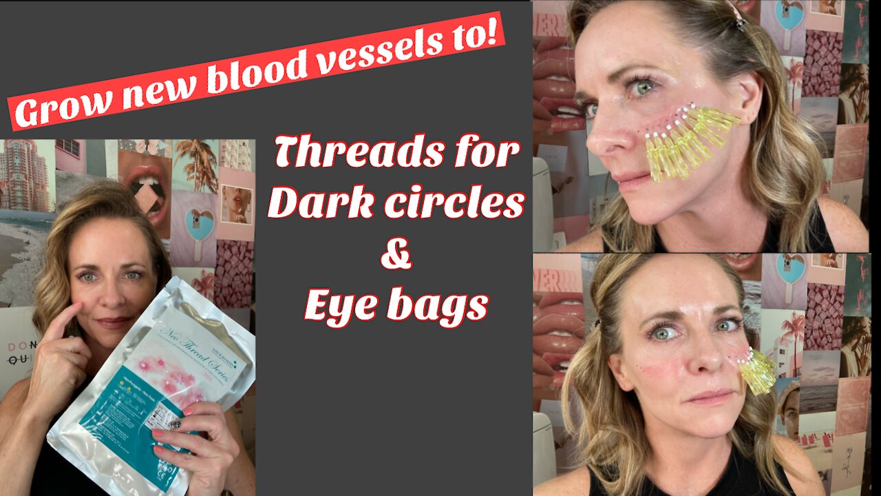 PDO Threads Under Eyes for Dark Circles | Also Grows New Blood Vessels