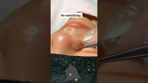 Satisfying White head removing #shorts #whiteheadremoval #skincare