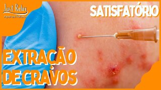 Satisfatório Remoção de Cravos - Remove Cravos e Espinhas Asmr - Just Relax | Apenas Relaxe