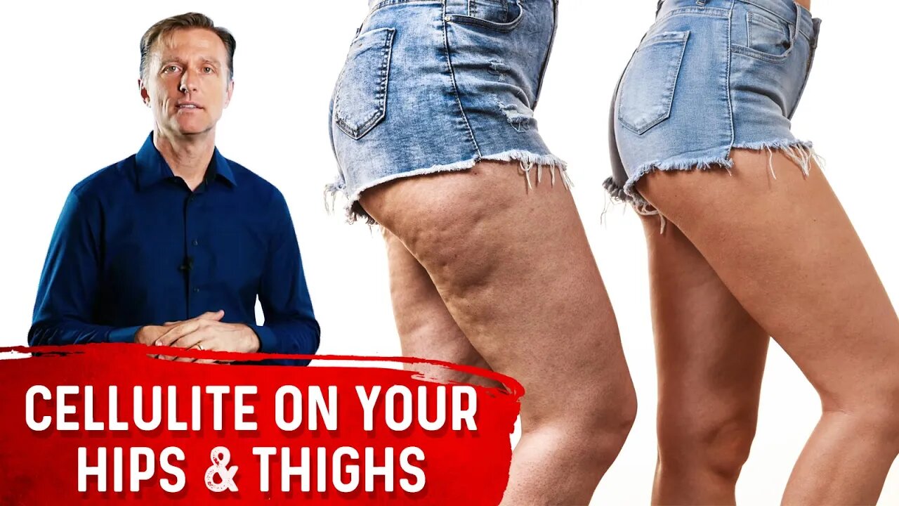 How To Get Rid Of Cellulite On Thighs & Buttocks? – Dr.Berg