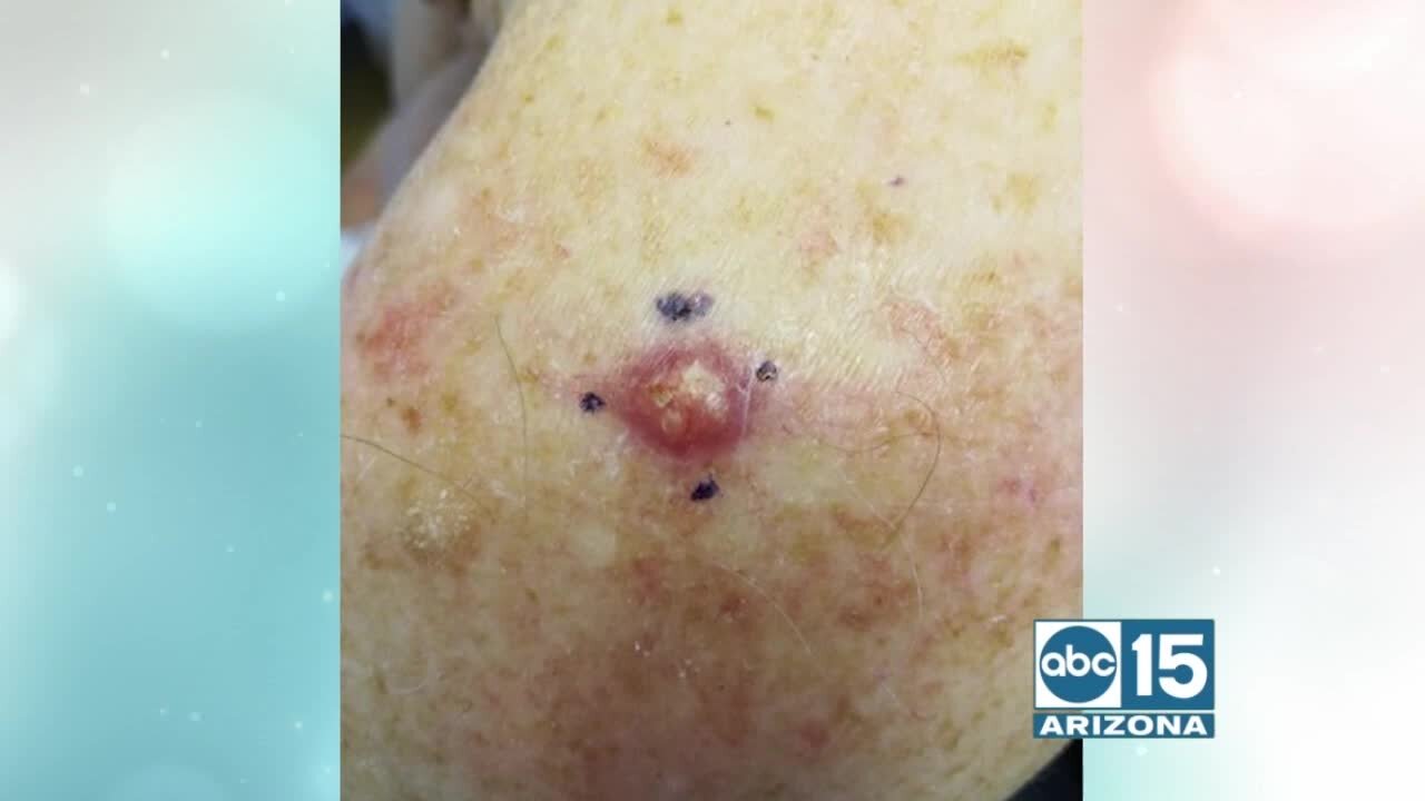 Skin cancer screenings available at Saguaro Dermatology