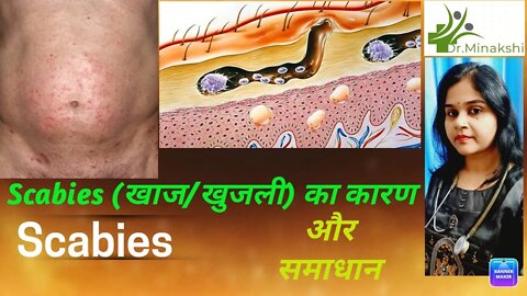 Scabies | खाज | खुजली| के कारण और उपचार scabies #खुजली का इलाज