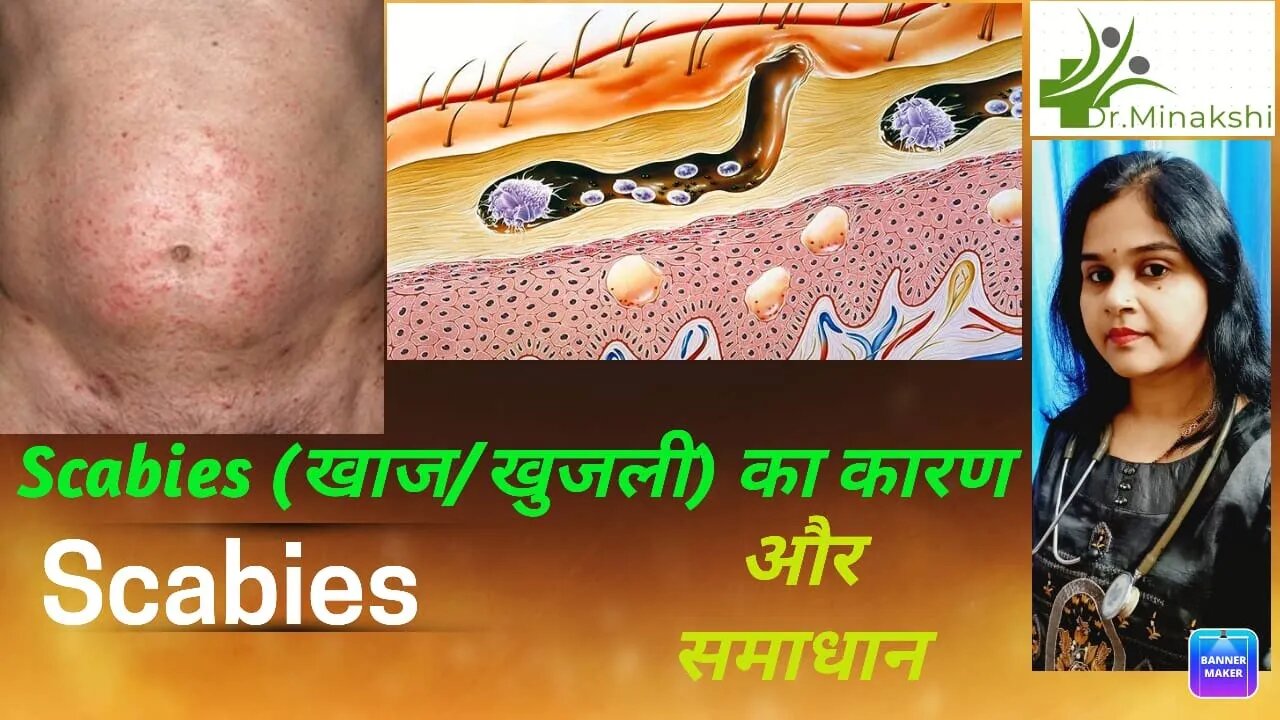 Scabies | खाज | खुजली| के कारण और उपचार scabies #खुजली का इलाज