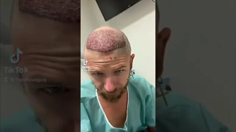 Reacting to Hair Transplant Tiktok Mashup 3