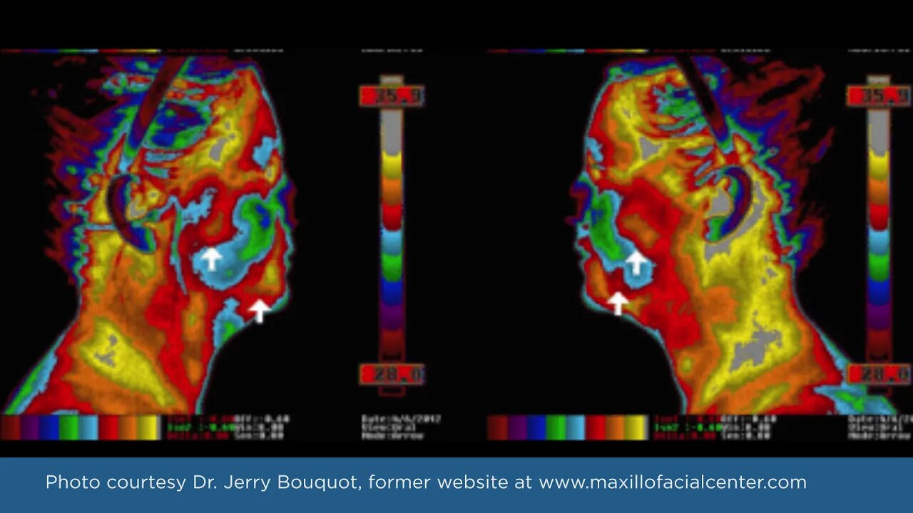 Detecting Ischemic Osteonecrosis in the Jaws