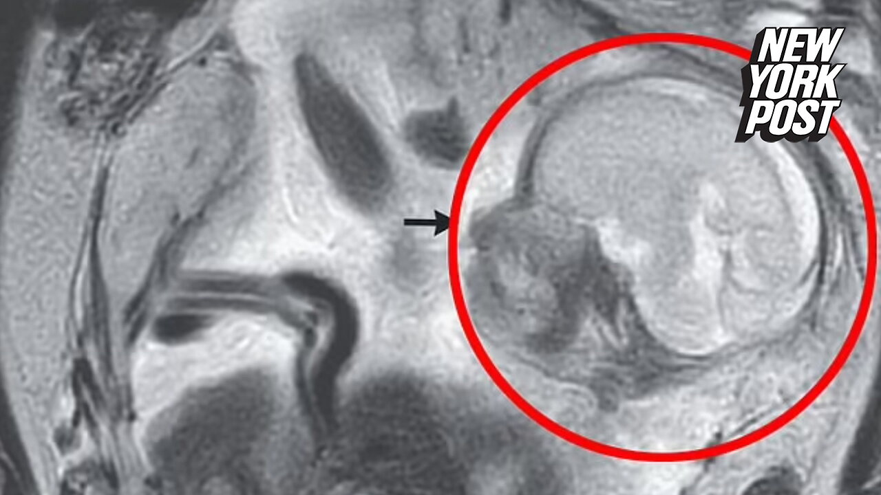 Woman with severe stomach cramps has baby growing in her abdomen