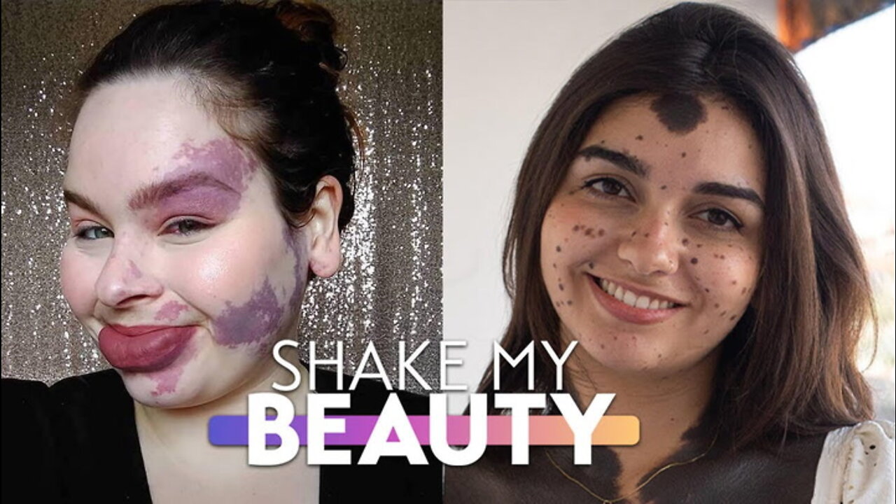 Living With Birthmarks | SHAKE MY BEAUTY