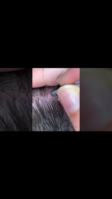 Hurting Ingrown Hair Extraction