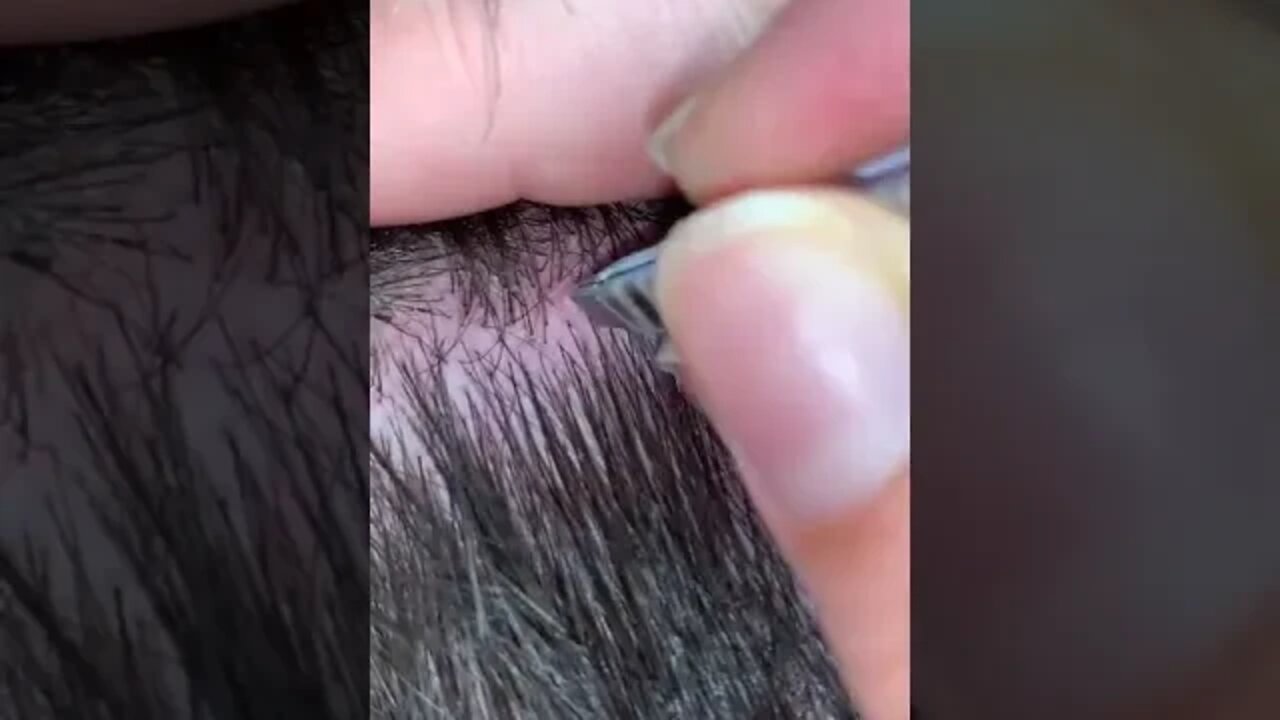 Hurting Ingrown Hair Extraction