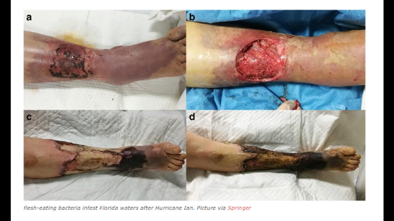 FLESH EATING BATERIA CASES ON RISE IN FLORIDA SINCE HURRICANE IAN