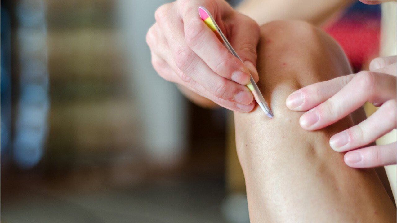 These are the best home remedies for ingrown hairs