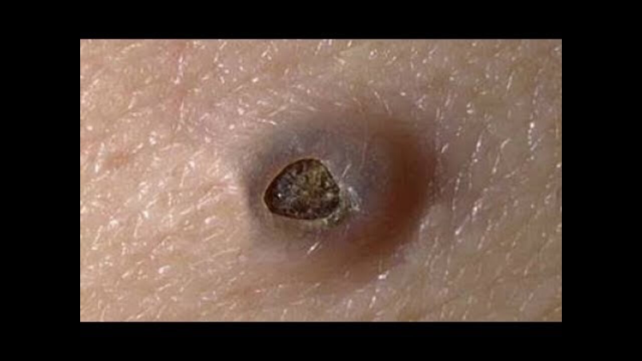 Blackhead Removal, Pimple popping, Acne Treatment #98