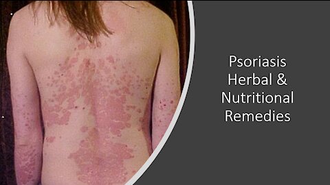 Psoriasis Natural Treatment