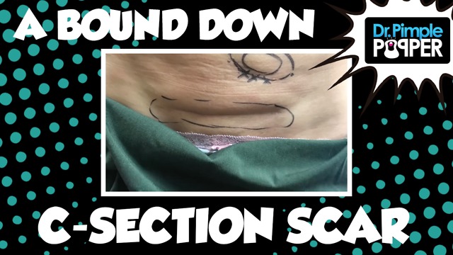 Release of Bound Down C section scar