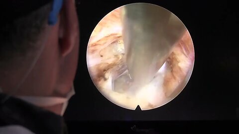 Transforminal Endoscopic Discectomy