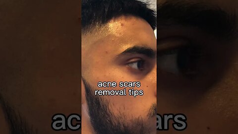 How to get rid of acne scars