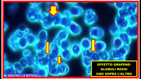 EFFETTO💉GRAFENE💉 NEL 🩸​:GLOBULI 🩸 ROSSI UNO SOPRA L’ALTRO