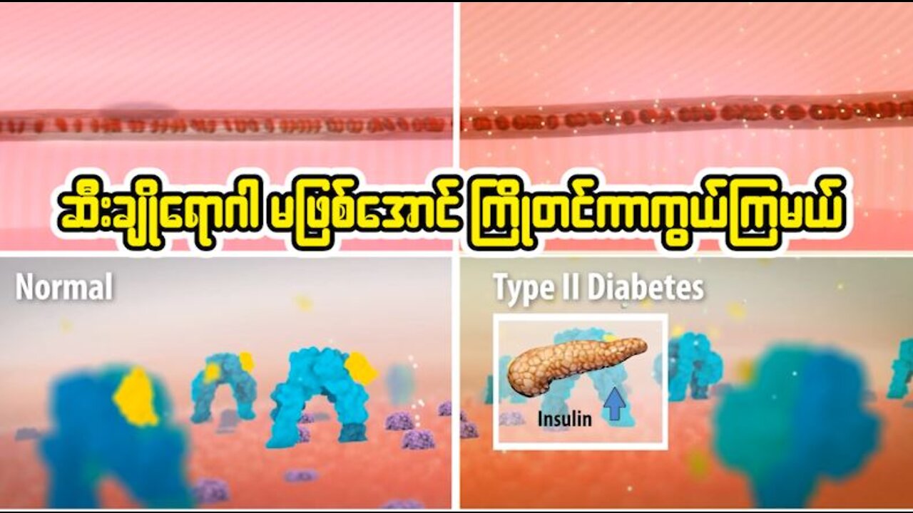 ဆီးချို မဖြစ်အောင် ကြိုတင်ကာကွယ်ကြရအောင်