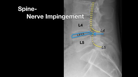 Spine Nerve Impingement