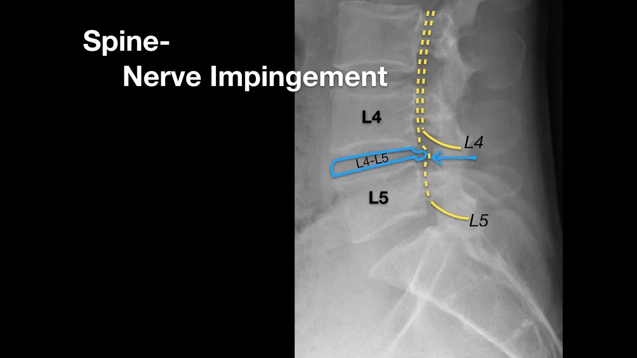 Spine Nerve Impingement