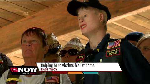 East Troy burn camp gives kids opportunity for acceptance
