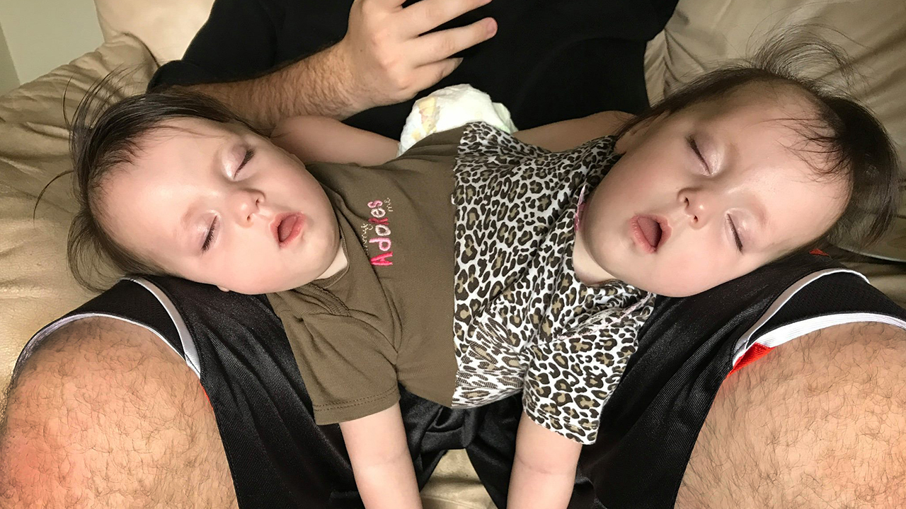 Conjoined Twins Are Perfectly Healthy And Have Bubbly Personalities
