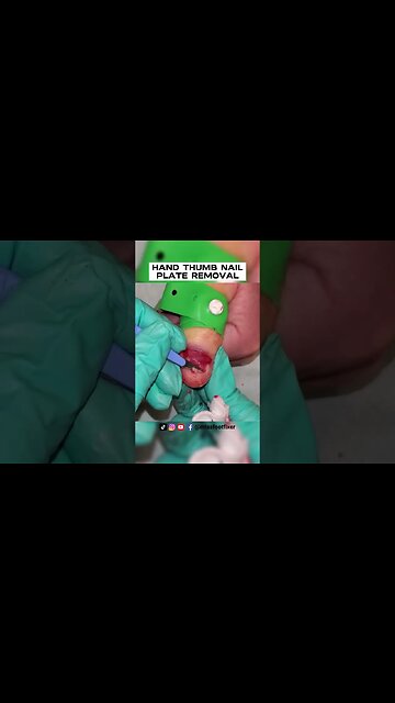 HAND THUMB NAIL PLATE REMOVAL [ NAIL AVULSION ] BY FOOT SPECIALIST MISS FOOT FIXER