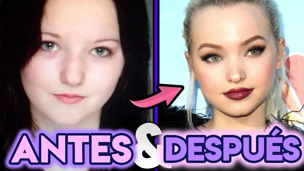 Dove Cameron | Transformación Antes y Después | Cirugías Estéticas