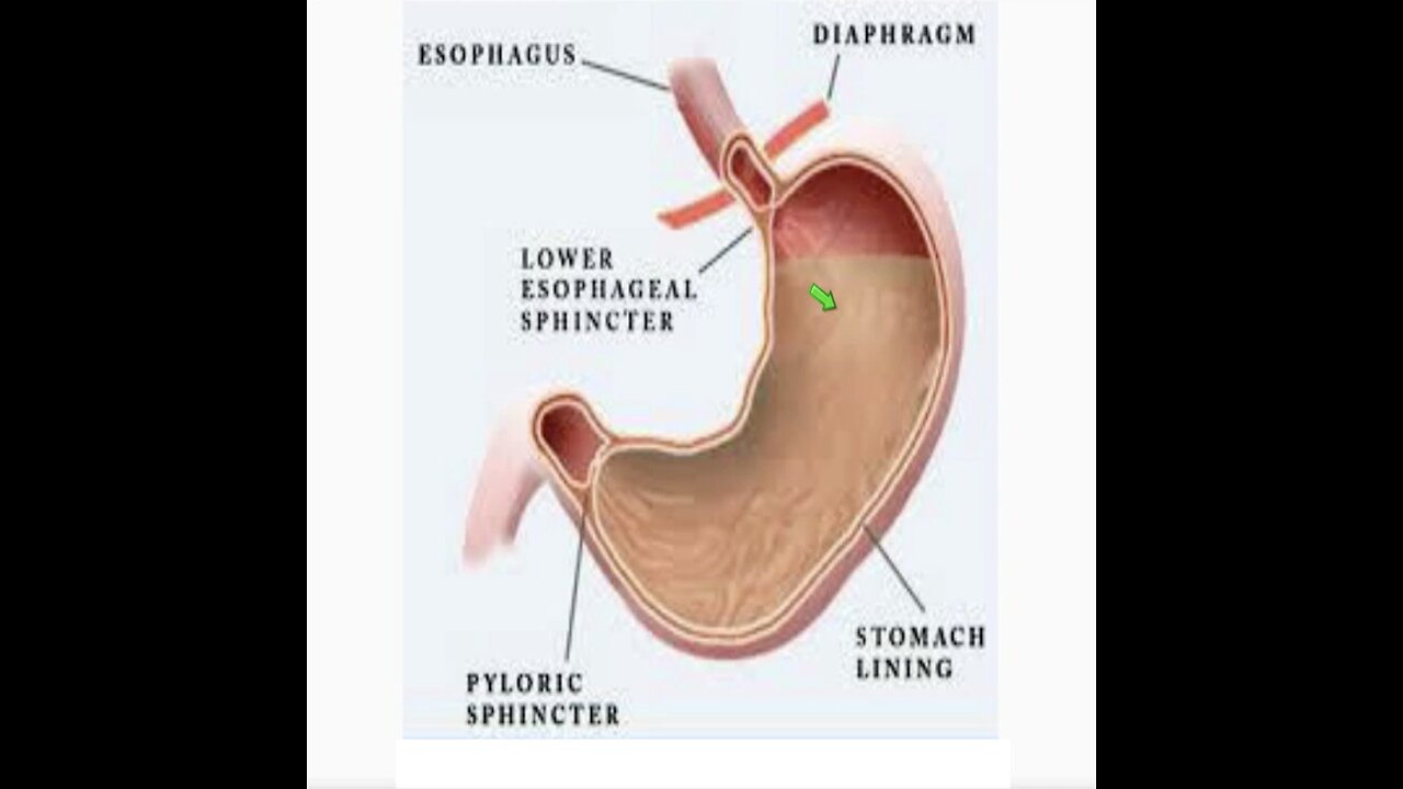 Apr. 2, 2024 AM / Acid Reflux, GERD & Heartburn and discussion...