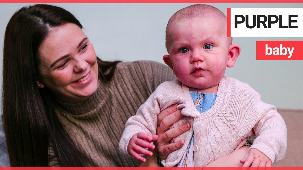 Mum hid daughter from strangers because of "purple" birthmarks