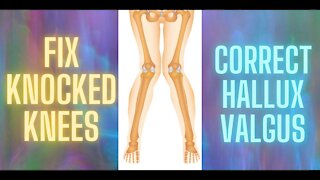 HOW TO FIX KNOCKED KNEES/BUNIONS