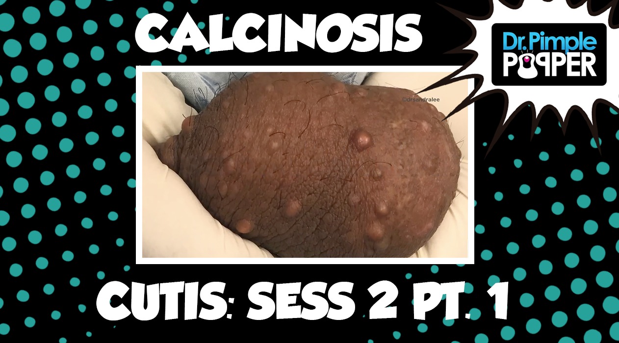 Calcinosis Cutis Session Two, Part One